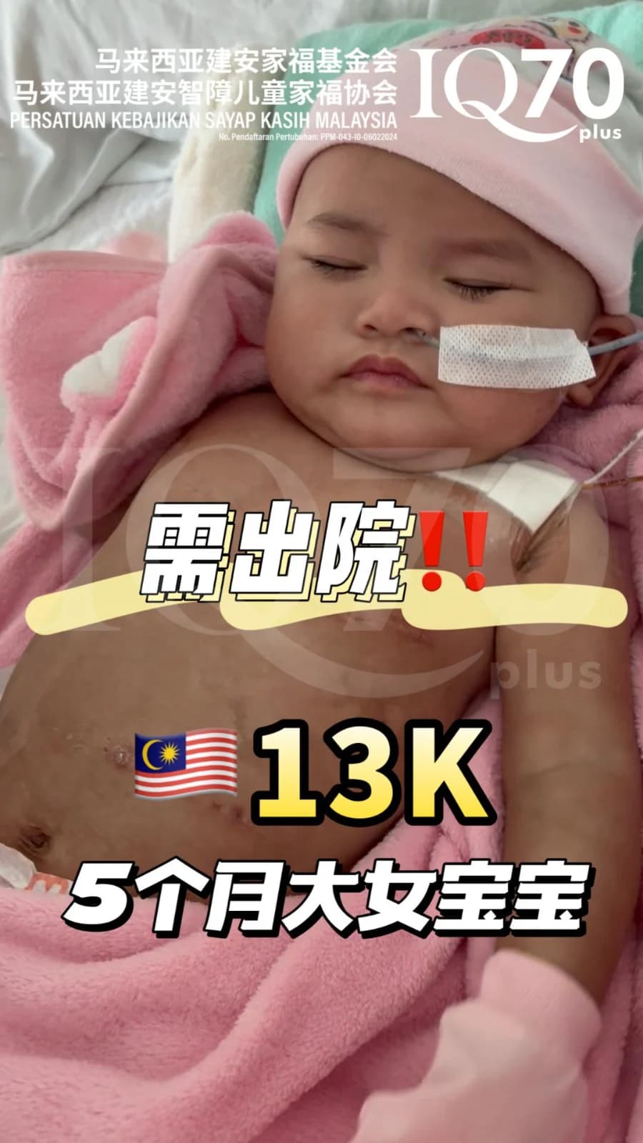 众筹个案编号 83 | 5个月大的 Julia,需要 RM13,725 医疗援助,盼顺利出院